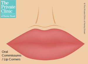 lip-filler-oral-commissures-lip-corners-lip-lift-mona-lisa-smile-300×218-1.png