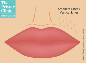 lip-filler-smokers-lines-vertical-lip-lines-wrinkles-300×218-1.png