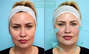 dermal filler treatment to tear trough, cheeks, mouth and chin results