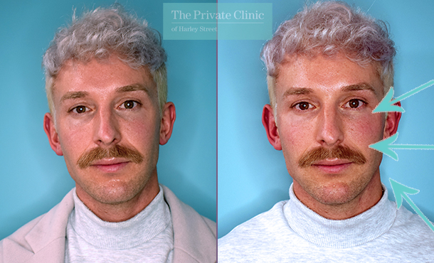 The Rise of Jawline Fillers for Men - The Cosmetic Skin Clinic
