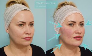 dermal filler treatment to tear trough, cheeks, mouth and chin results