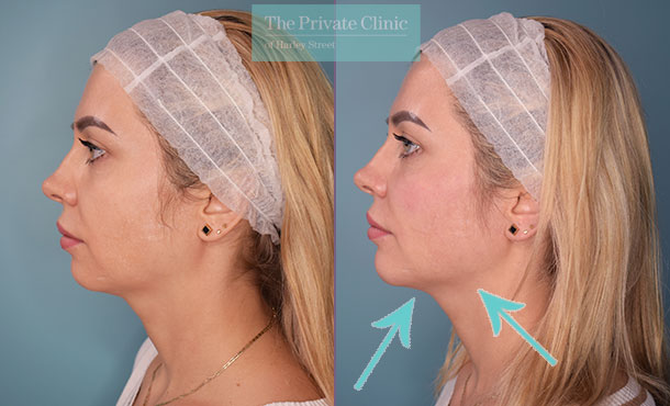 dermal filler to the jawline before and after results image