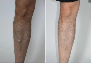 VenaSeal Before and After Photos legs