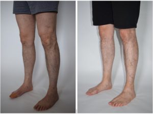 VenaSeal Before and After Photos
