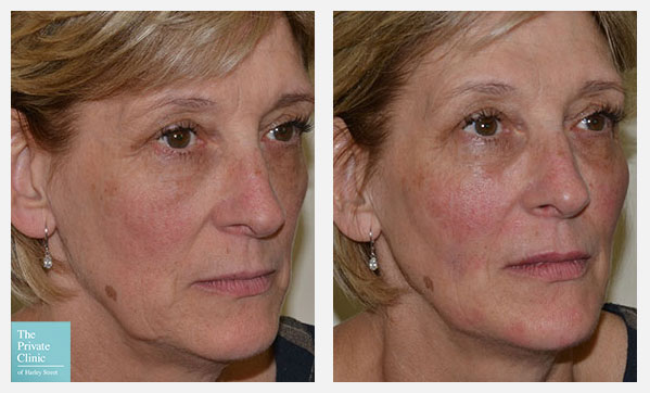 8-point-fluid-facelift-dermal-filler-before-after-northampton-results