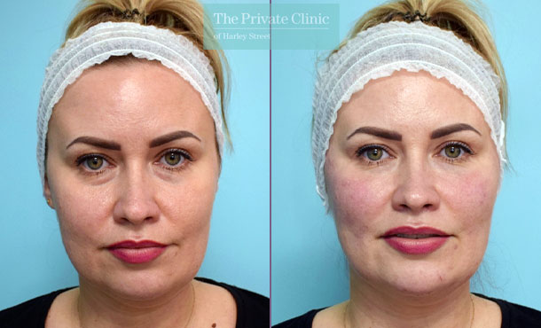 dermal filler treatment to tear trough, cheeks, mouth and chin results