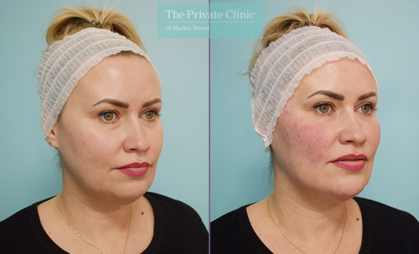 dermal filler treatment to tear trough, cheeks, mouth and chin results