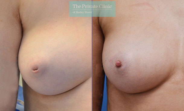 Before and after photos of patient after inverted nipple surgery showing reverted nipple