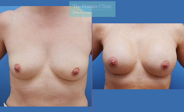 Breast Augmentation - 009AF-Front