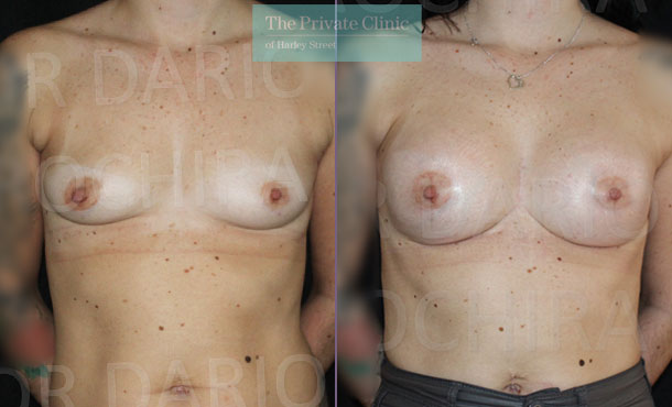 Breast Augmentation - 005DR-Front