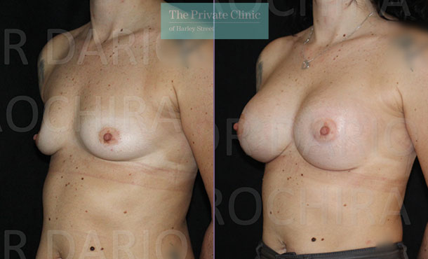 Breast Augmentation - 005DR-Side