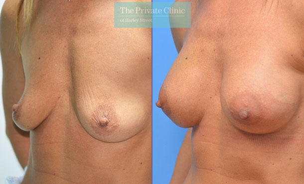 Breast Augmentation - 008AF