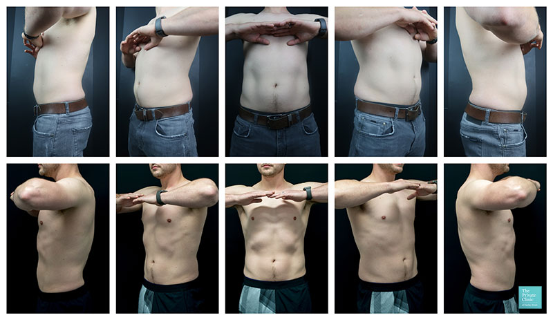 coolsculpting male abdomen before and after photos