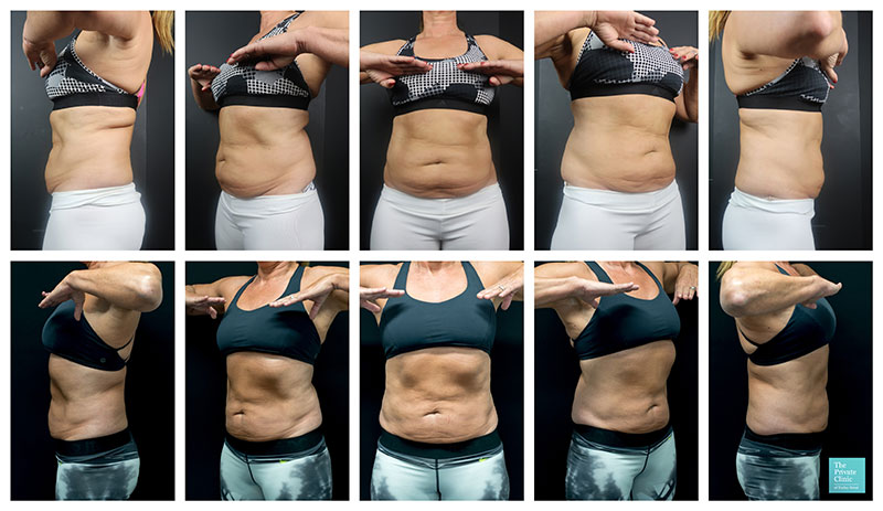 Belly Fat Freezing with CoolSculpting, CoolSculpting Stomach/Abdomen Before  and After photos