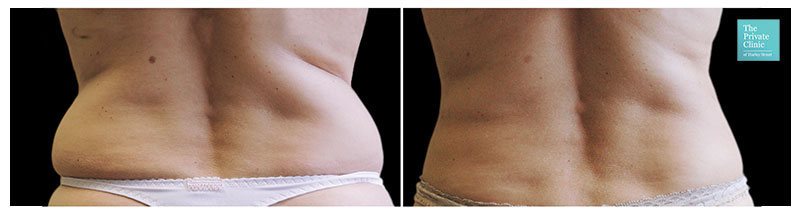 CoolSculpting Love Handles, Coolsculpting flanks before and after