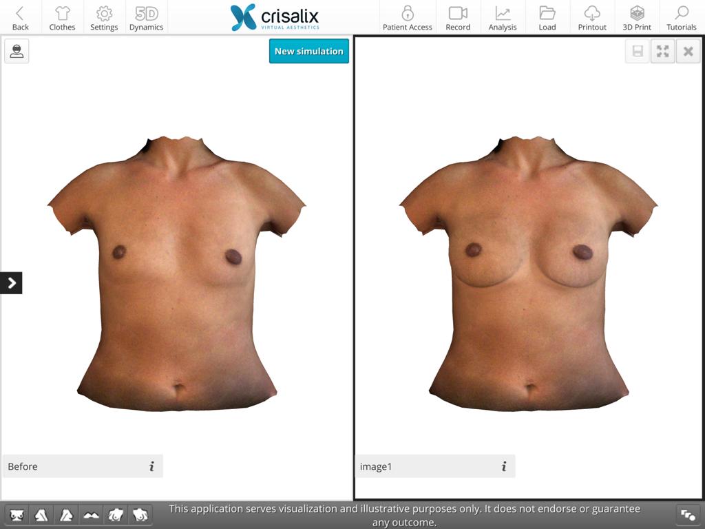 How do you see what you would look like with breast augmentation
