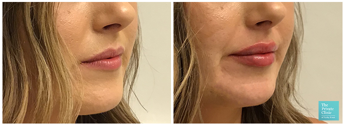 lip fillers birmingham before after photo