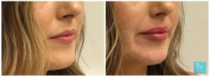 Photos showing before and after results of dermal lip filler with patient having much fuller lips after treatment