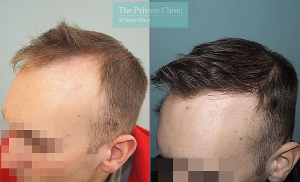 FUE Hair Transplant - 023MM-Side