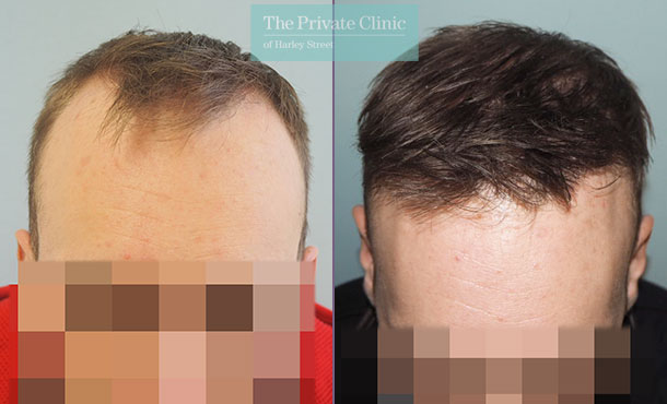 FUE Hair Transplant - 023MM-Front