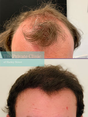 FUE Hair Transplant before and after results showing fuller head of hair