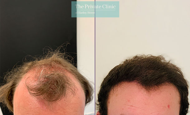 FUE Hair Transplant - 005FR