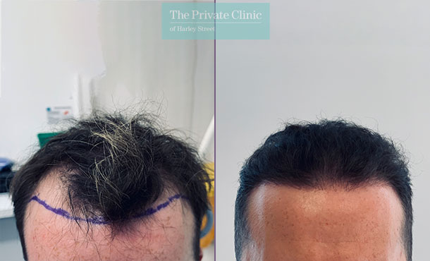 FUE Hair Transplant - 004FR-Front