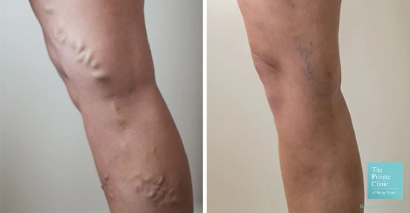 before and after photos of the result of varicose vein treatment with EVLA