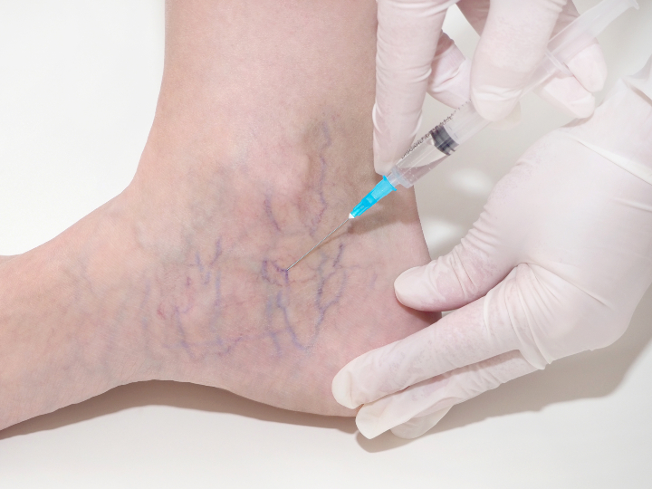veins in ankle being injected during sclerotherapy treatment