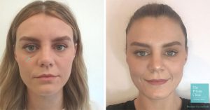 Before and after photos of patient having had dermal filler tear trough treatment with eyes looking brighter and under eye darkness reduced