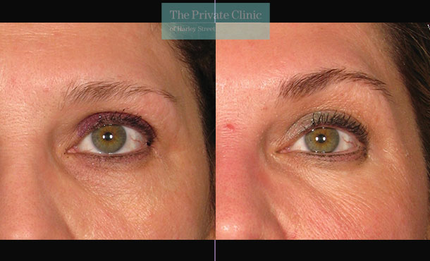 Ultherapy browlift treatment before and after photos showing lifted brows