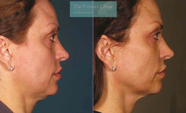 Ultherapy before and after photo showing a more defined jawline and lifted face