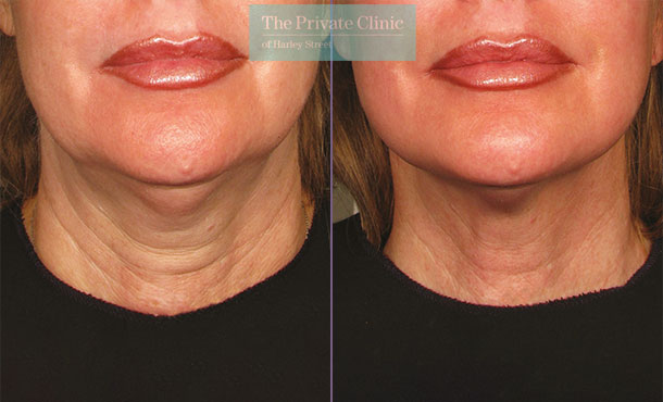 Ultherapy treatment before and after results showing a reduction of sagging skin on the neck