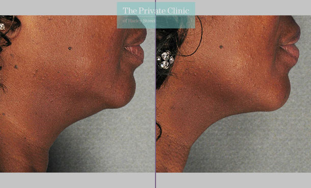 Ultherapy treatment before and after results showing reduction in jowls and more defined neck