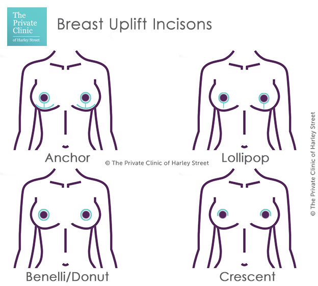 breast uplift surgery incision areas