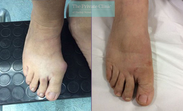 Double Bunion Removal Surgery before after photo