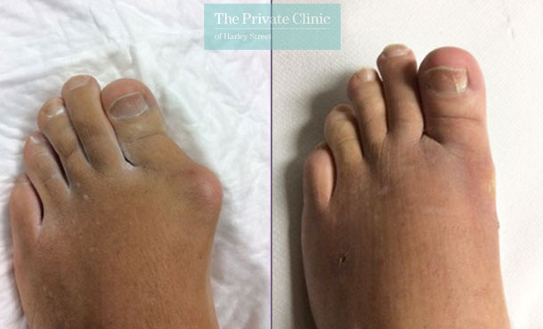 bunion corrective surgery before and after results pictures