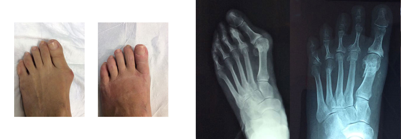 Bunion surgery before after photos UK 2023