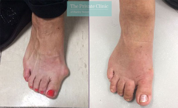 bunion surgery results hallux valgus removal before after photo