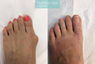 minimally invasive bunion surgery before after photo