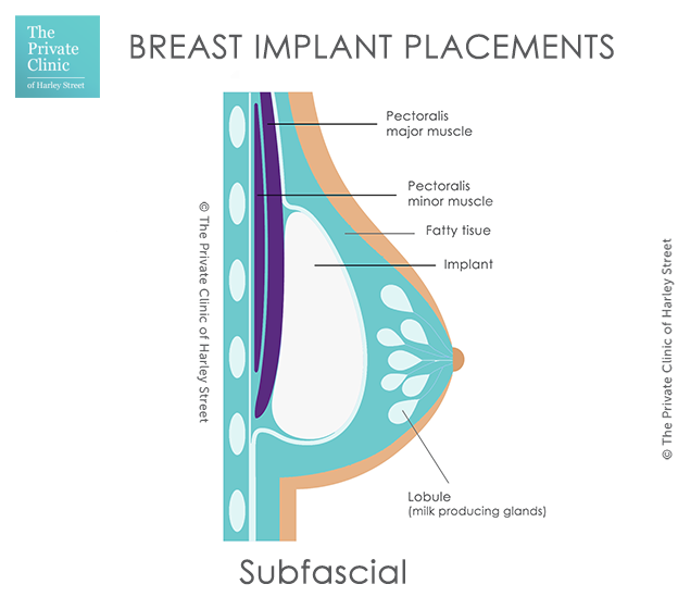 breast implant placement subfacial