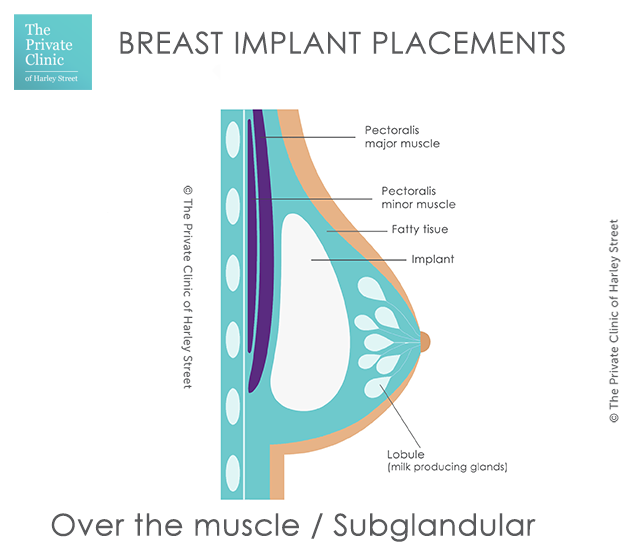 Your Guide to Breast Implant Placement: The Pros & Cons of Each