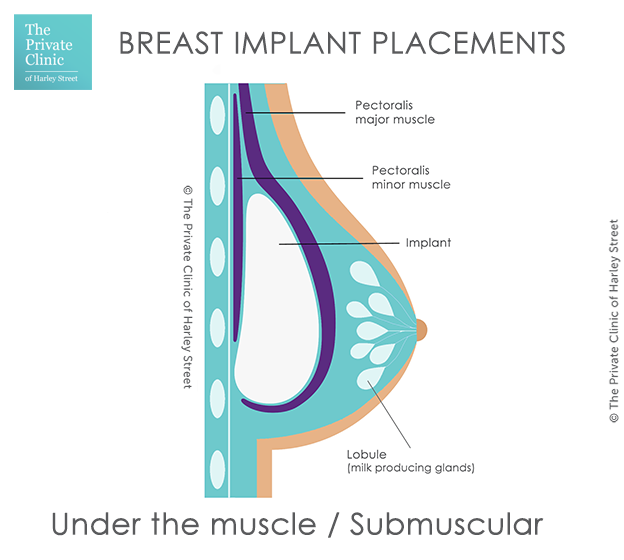 under the muscle placement for breast implants