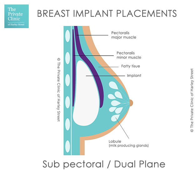 Breast Implant Placement option dual plane