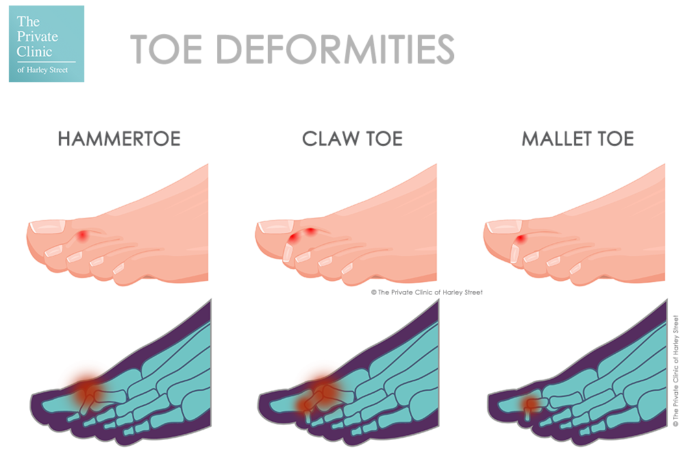 Hammer toes, claw toes, mallet toes treatment: hammer toes