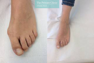 keyhole bunion surgery uk before after photo