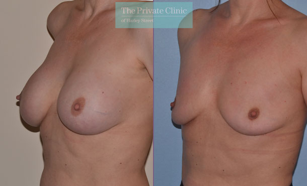 Breast implant removal results