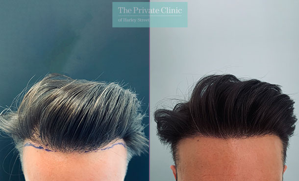 FUE Hair Transplant - 006FR-Front