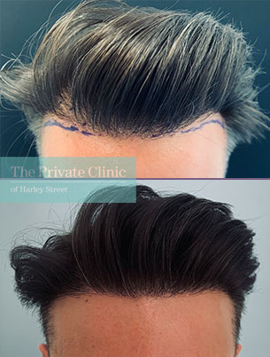 fue hair transplant before and after photo showing results