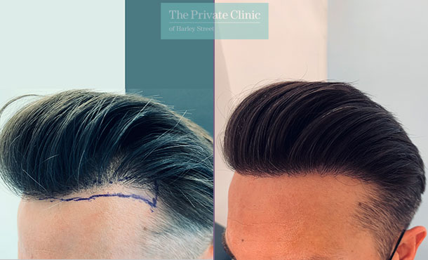 FUE Hair Transplant - 006FR-Side